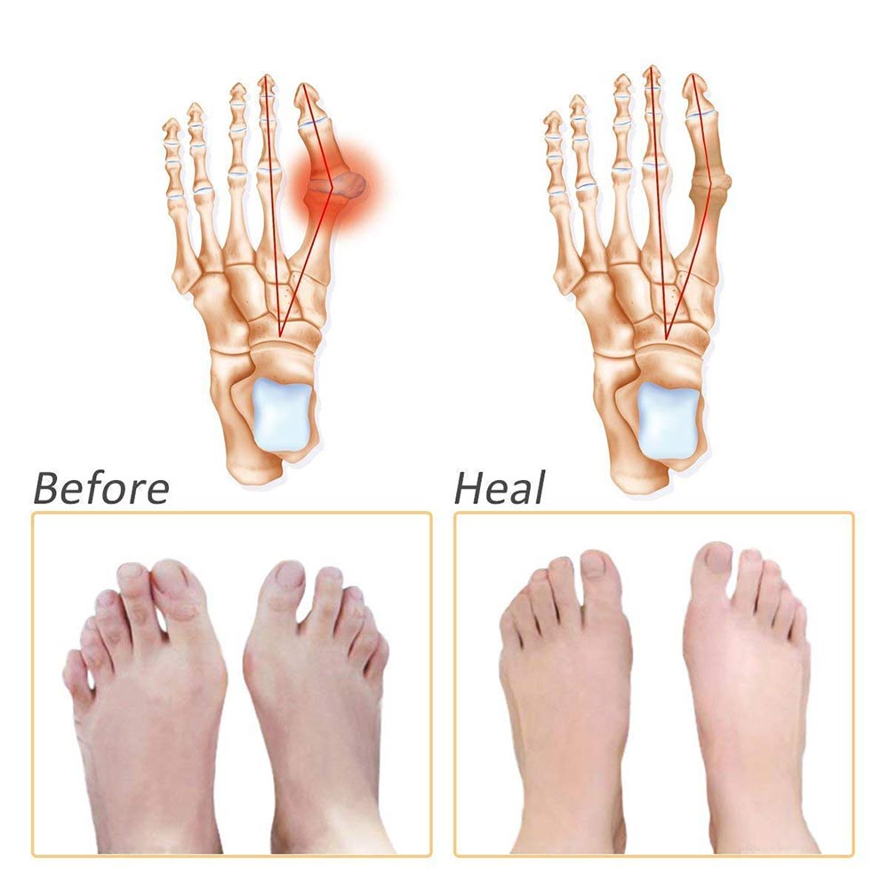 1 - K Kudos Toe Pad,  2 Piece(s)/Pack 